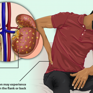 10 Kidney Infection Signs and Symptoms
