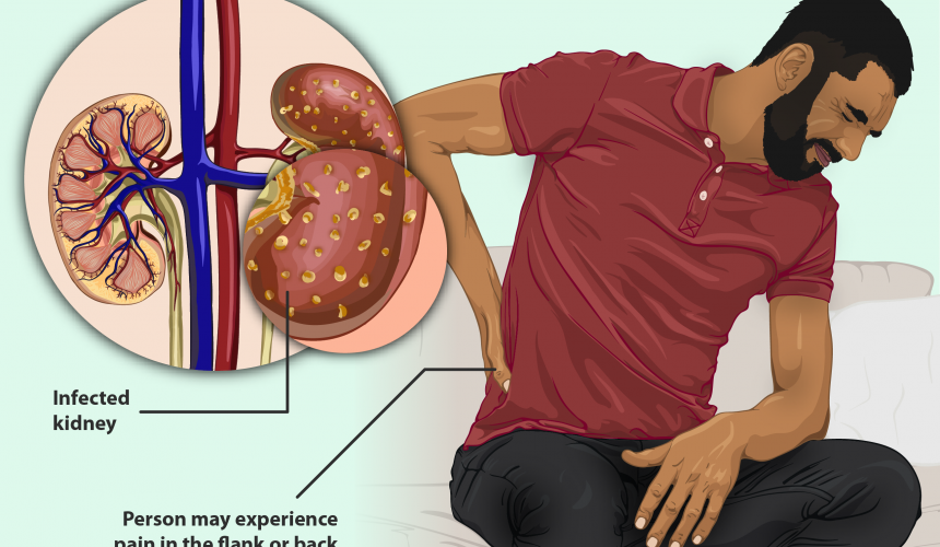 10 Kidney Infection Signs and Symptoms